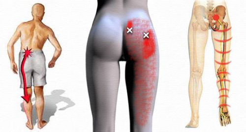 pain caused by sciatica may be different