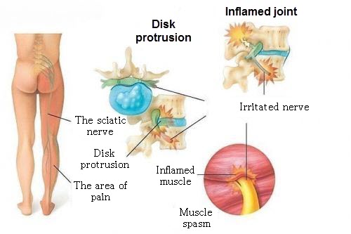 the nerve is squeezed